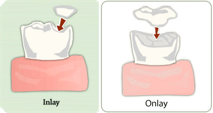 dental-inlay-dental-onlays